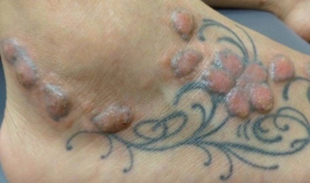Estos son los riesgos que hacerte un tatuaje puede tener para tu salud $!Estos son los riesgos que hacerte un tatuaje puede tener para tu salud