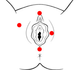 ‘Vulvodinia’, el dolor crónico de la vulva que muchas mujeres viven en silencio $!‘Vulvodinia’, el dolor crónico de la vulva que muchas mujeres viven en silencio