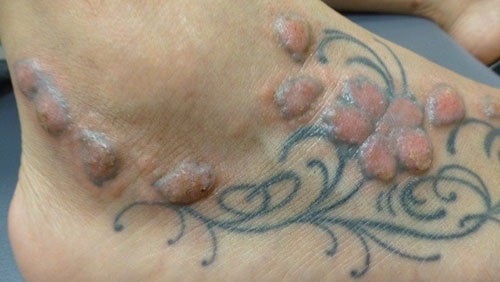 Estos son los riesgos que hacerte un tatuaje puede tener para tu salud $!Estos son los riesgos que hacerte un tatuaje puede tener para tu salud