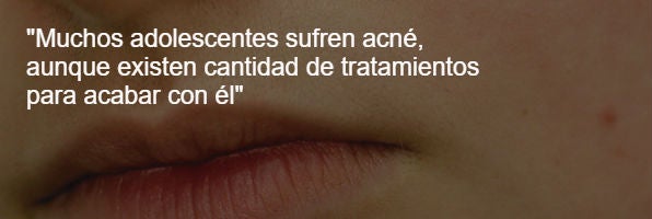 acne-mileniales-codigo-nuevo $!acne-mileniales-codigo-nuevo