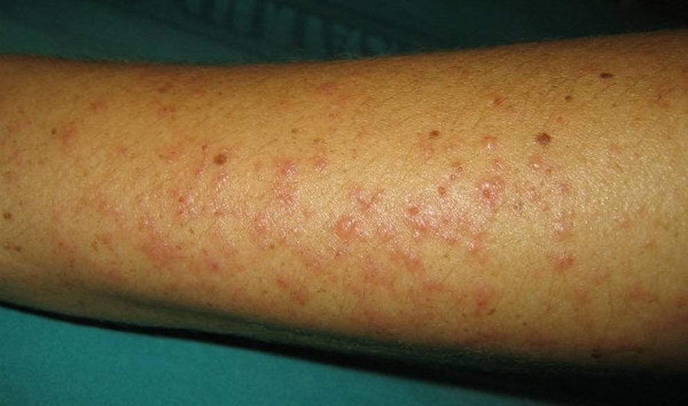 La alergia al sol puede aparecer en cualquier momento y estos son sus síntomas $!La alergia al sol puede aparecer en cualquier momento y estos son sus síntomas