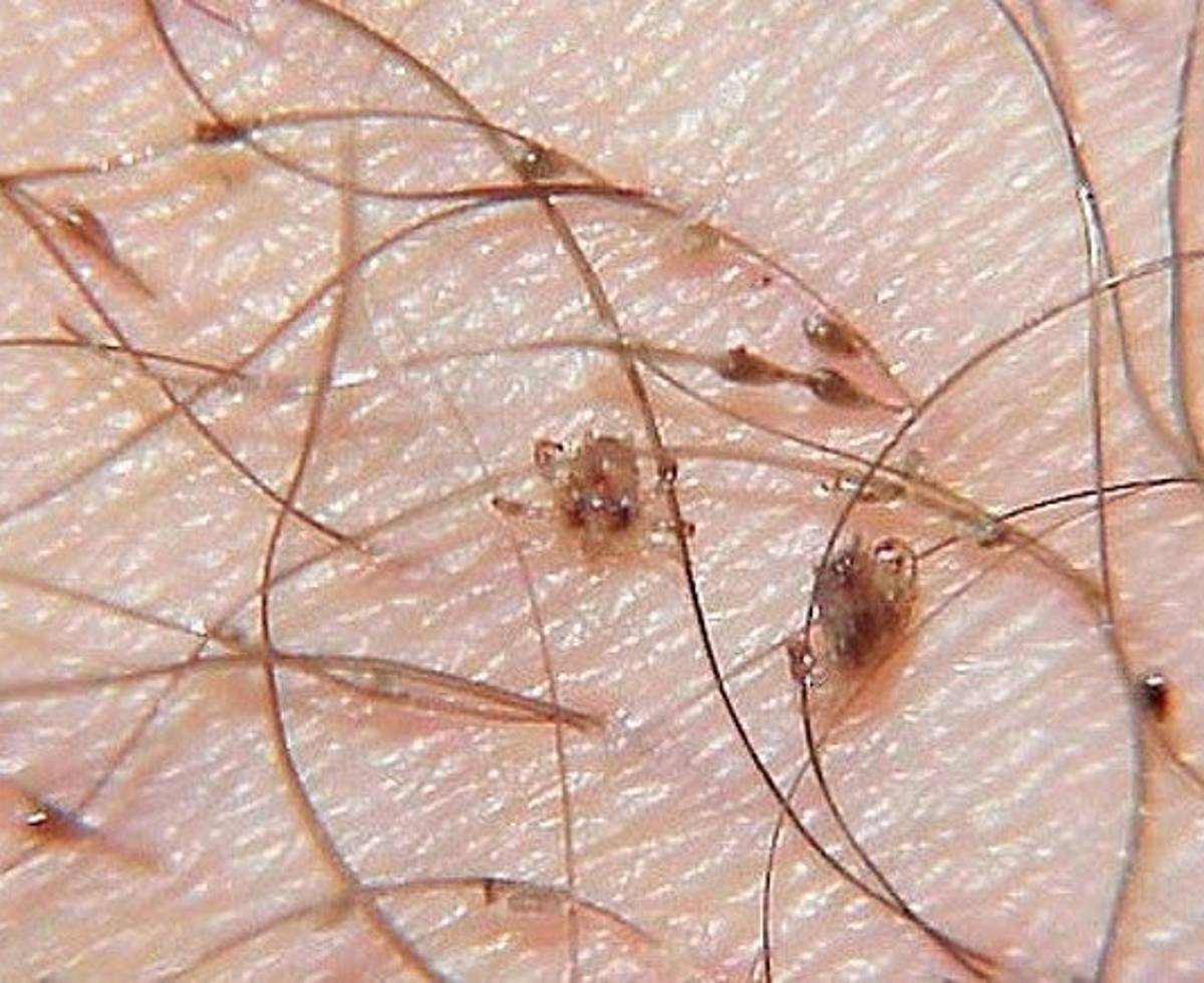¿Que Son Las Ladillas Y Porque Salen?
