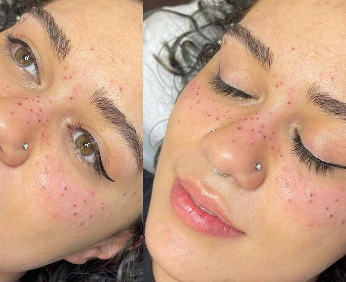 TATUAJE PECAS | Tatuarse pecas está de moda, pero ¿qué peligros conlleva?, image size:1200x980