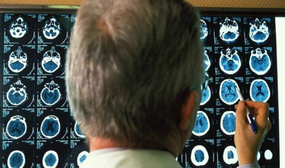 Esto es lo que los científicos quieren hacer para frenar el Parkinson y el Alzheimer