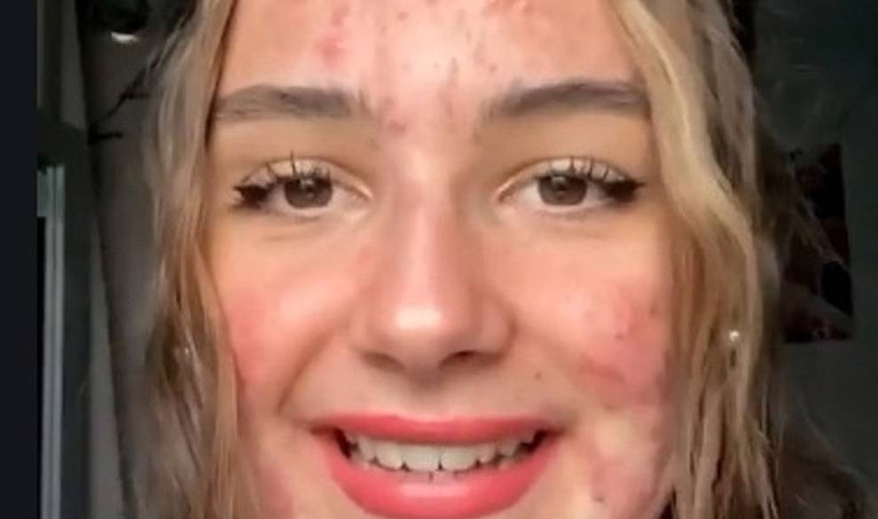 La joven con acné severo que comparte su día a día en TikTok