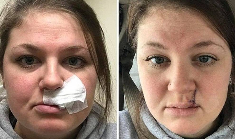 Una mujer comparte su cicatriz de cáncer de piel para advertir contra los rayos UVA