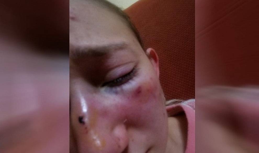 Fracturan la nariz a una chica de 18 años por no querer dar su Whatsapp