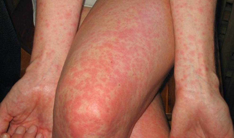 La alergia al sol puede aparecer en cualquier momento y estos son sus síntomas
