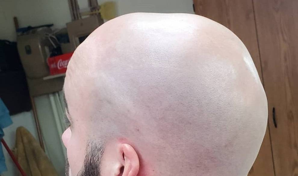 Fui a un psicólogo de calvos para que me enseñara a amar mi alopecia