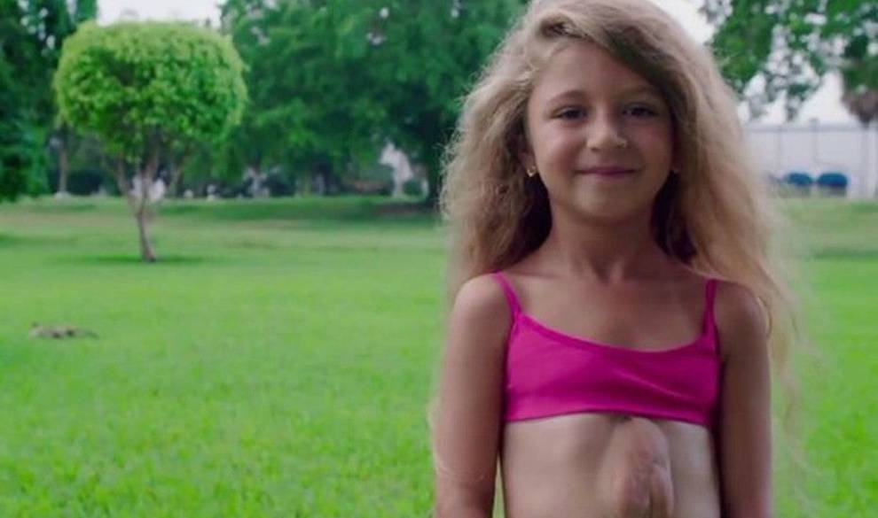 La asombrosa historia de la niña que vive con el corazón fuera de su pecho