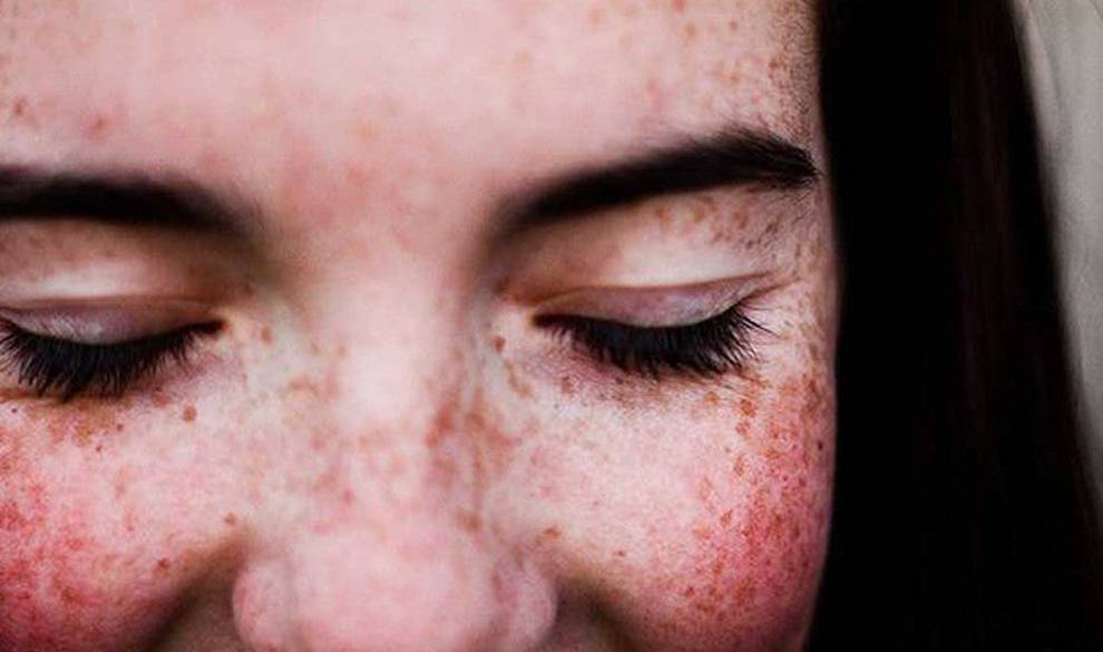 Las Pecas Son Miles De Puntitos A Tu Favor Y Estas Cosas Que Crees Que Son Defectos, También
