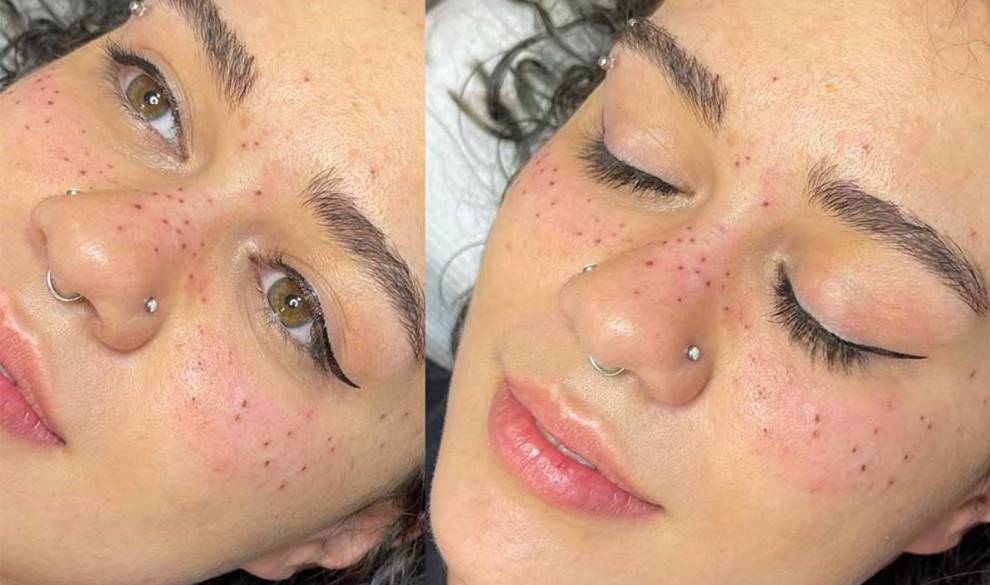 La moda de tatuarse pecas en la cara, ¿es seguro?